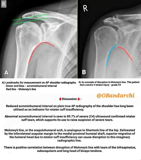 ap plain|Acromiohumeral interval .